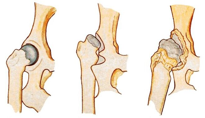 Hip dysplasia is a cause of secondary coxarthrosis. 