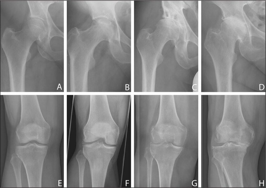 Osteoarthritis of the hip joint in dynamics. 
