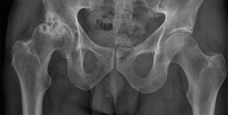 Stage 3 osteoarthritis of the hip joint on an x-ray