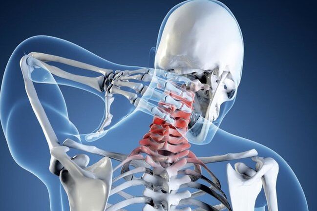 Osteochondrosis of the cervical region