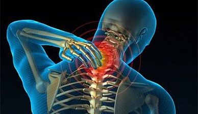 Symptoms of osteochondrosis of the cervical column