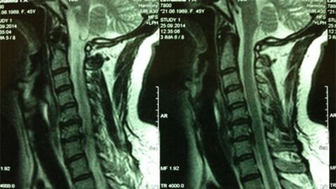 MRI of the Department of Cervical