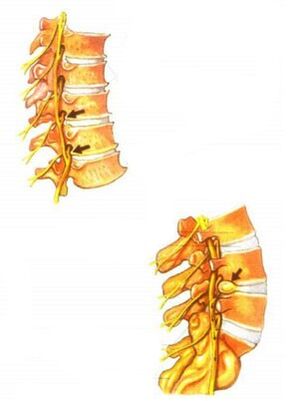 Illustration of osteochondrosis of the spine. 