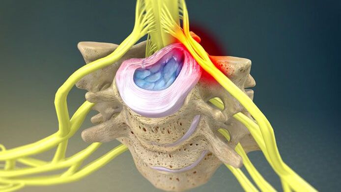 The bulging of the intervertebral disc is the cause of neck pain. 