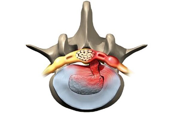 vertebra affected by osteochondrosis